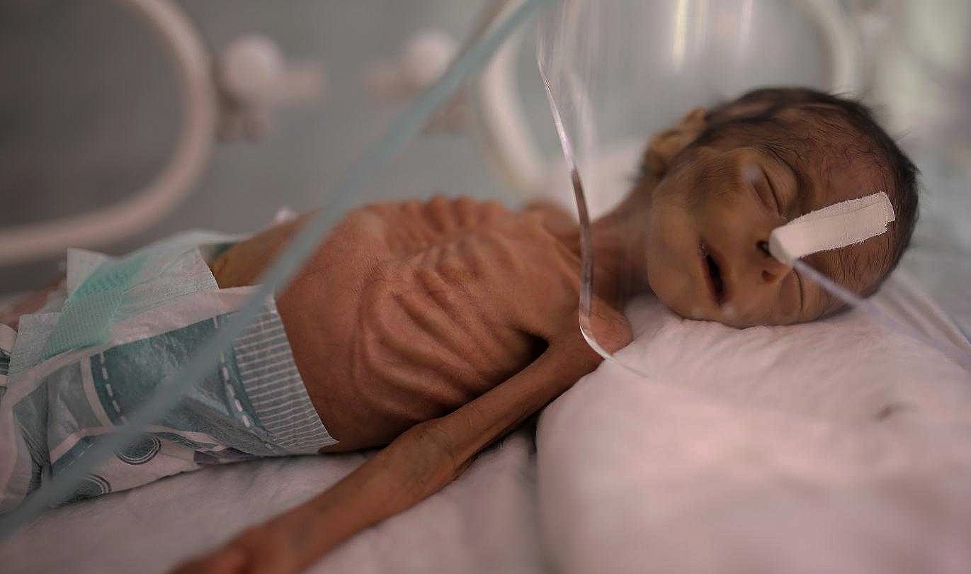 أزمة الجوع العالمية تهدد الملايين في اليمن.. وتدفع طفلاً واحداً كل 15 دقيقة إلى معاناة سوء التغذية الحاد