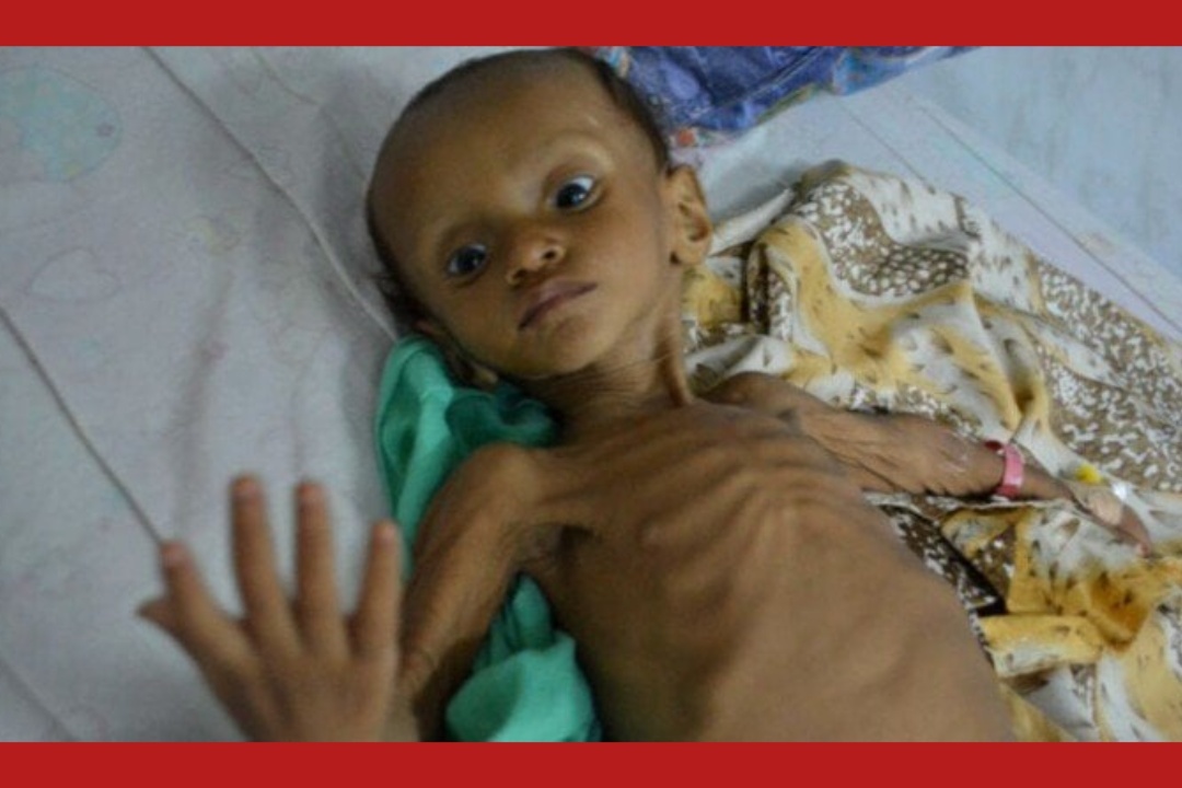 الأمم المتحدة تحذر من انتشار وباء الكوليرا في اليمن.. بينما لاتزال تتحفظ على تمويل خطة الاستجابة الانسانية لهذا العام
